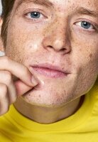 Пластирі з мікроголками для ранніх стадій прищів Acnemy ZITLESS 5х patches with microdarts for early-stage pimples — Фото 13